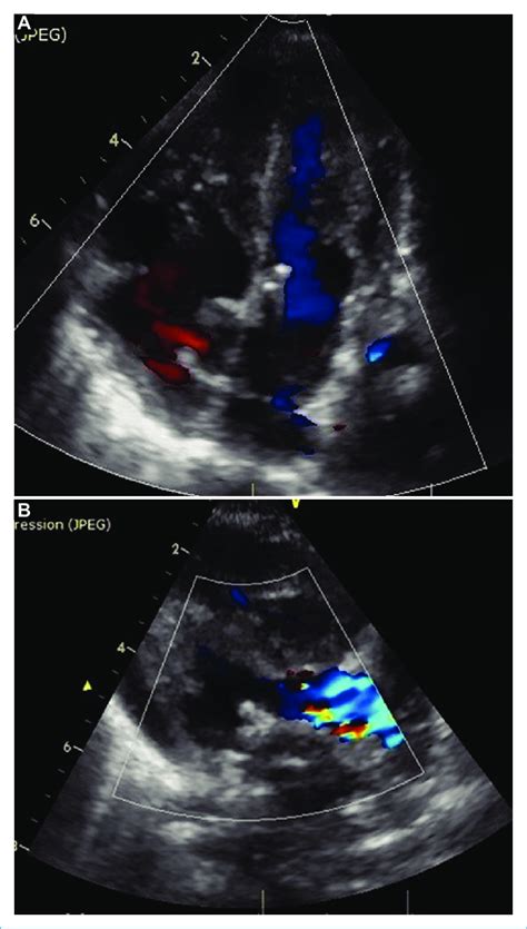 Follow Up Echocardiogram A Melody Valve In Mitral Position With