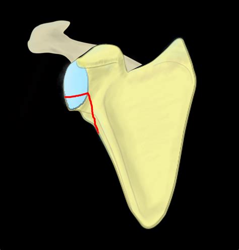 Fractures Of Glenoid Of Scapula Ideberg Classification