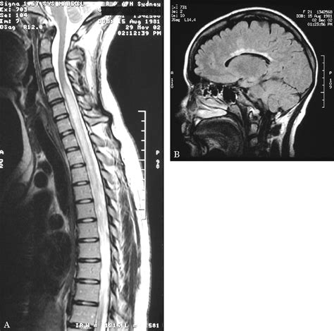 Tm may be due to a virus or other infection, but in general, the cause is unknown. Acute transverse myelitis in SLE | Neurology