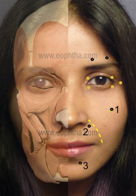 Facial Hemi Spasticity Telegraph