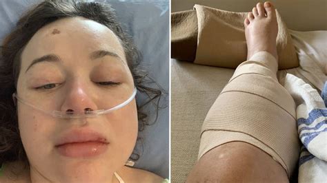 Mum Almost Needed Her Legs Amputated After Waking Up From Girls Night Out
