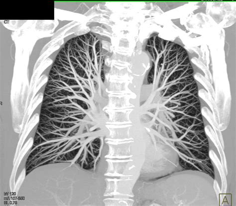 Mip Imaging Of Normal Pulmonary Vasculature Chest Case Studies