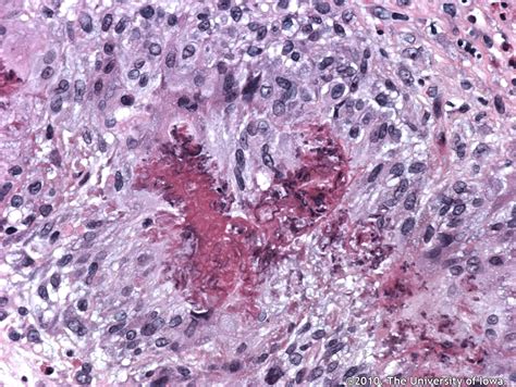 Churg Strauss Syndrome With Orbital Inflammation