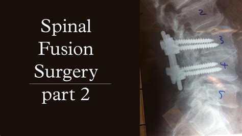 How Long Is Spinal Fusion Surgery Designatorsperplexity