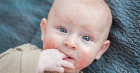 8 Newborn Skin Conditions To Look Out For