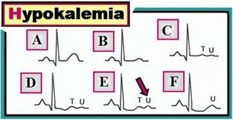 Hypokalemia Disease With Causes Symptom And Nursing Intervention