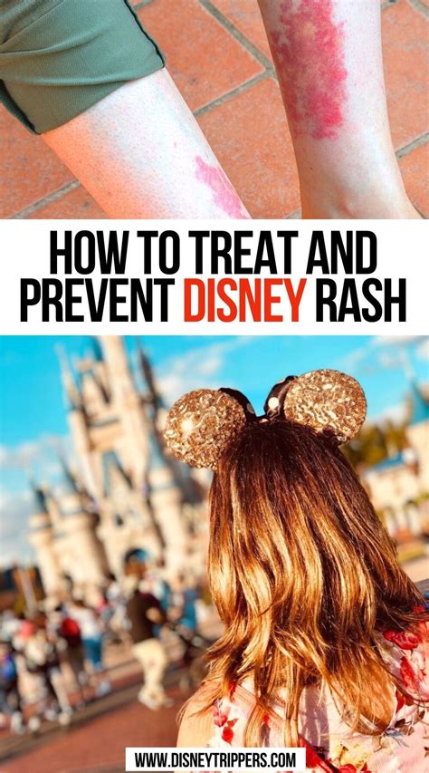 How To Treat And Prevent Disney Rash Disney On A Budget Disney