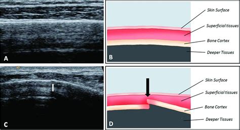 Imaging Of Rib Stress Fractures In Elite Rowers The Promise Of