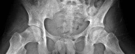 Femoroacetabular Impingement Fai Hip Impingement Specialist Hip