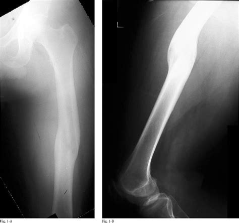 Figure 1 From The Clamshell Osteotomy A New Technique To Correct