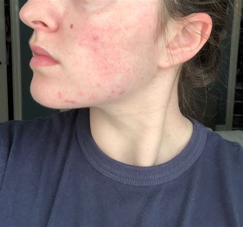 My Tretinoin Journey How I Finally Cured My Hormonal Acne