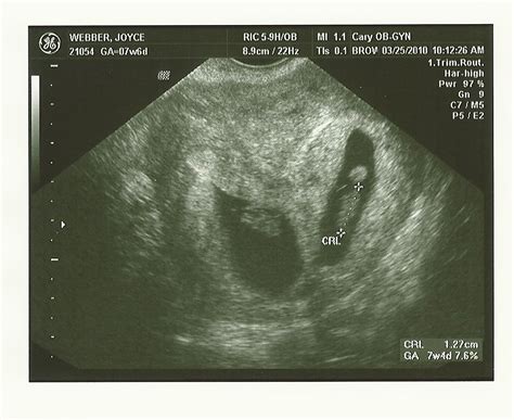 Two For One Special 8 Week Ultrasound Pictures