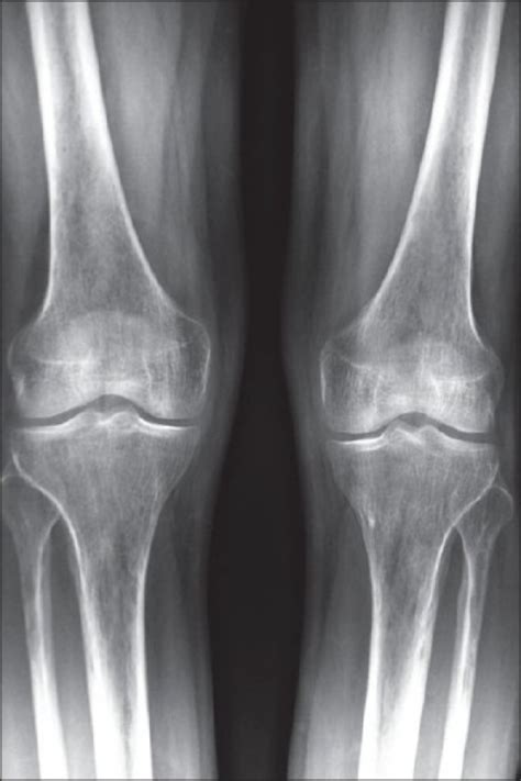 X Ray Of Both Knees Showing Osteoporosis Open I
