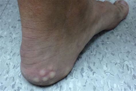 Bumps On Heels Of Feet Genertore2