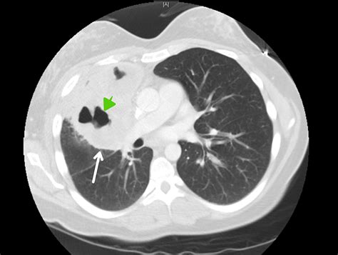 Cureus Primary Pulmonary Hodgkins Lymphoma A Rare Etiology Of A