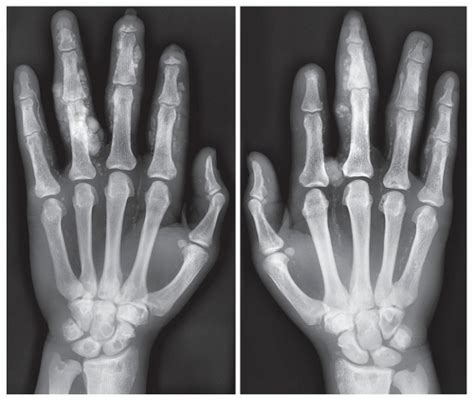 Osteoporosis Rickets And Osteomalacia Radiology Key