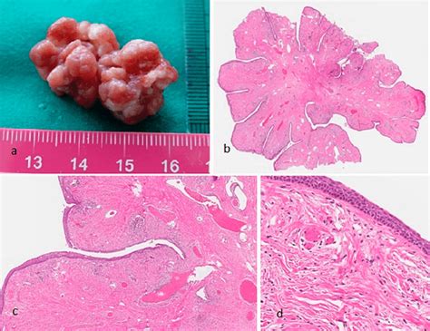 The Macroscopic View Of The Removed Fibroepithelial Polyp A And Its