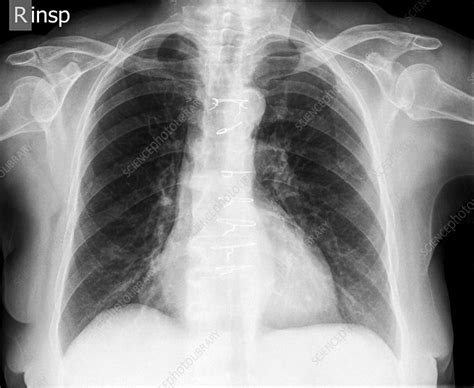 Normal Chest X Ray Stock Image C0197404 Science