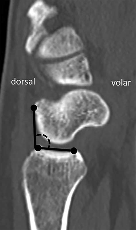 Evaluation Of Dorsal Subluxation Of The Scaphoid In Patients With