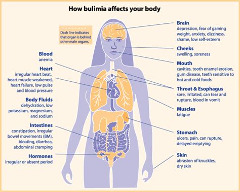 Bulimia Nervosa The Media And Body Image