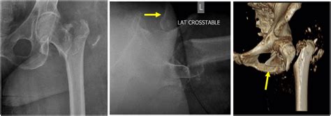 Preoperative Films And Ct Showing Unstable Intertrochanteric Fracture