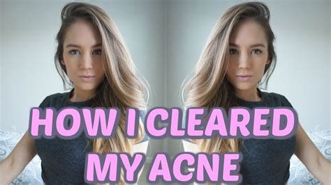 How I Cleared My Acne Youtube