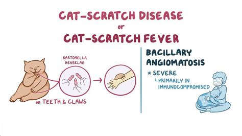 Bartonella Henselae Cat Scratch Disease And Bacilary Angiomatosis