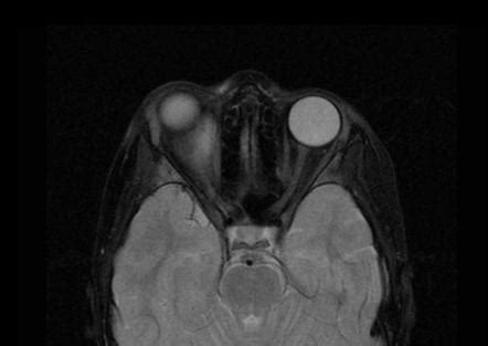 Orbital Subperiosteal Hematoma Image Radiopaedia Org