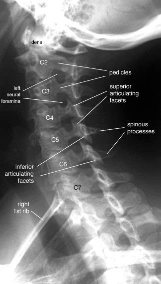 Oblique Cervical Spine Xray