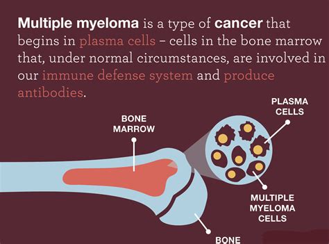 Multiple Myelomawhat To Know