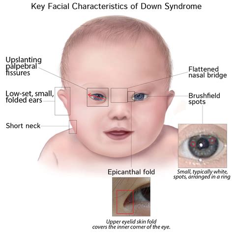 A case of de novo mosaic 18q21.3 deletion with a mild phenotype | mosaicism, phenotype and chromosomes | researchgate, the professional network for scientists. Flat Nasal Bridge And Epicanthal Folds : Down Syndrome Amboss - yoursjuliette