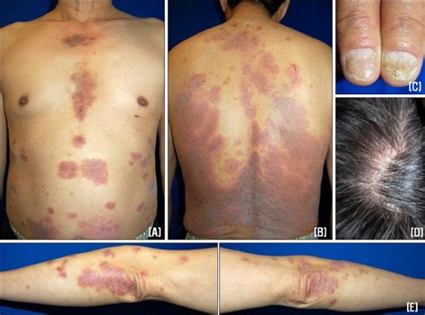 Multiple Sharply Demarcated Erythematous Plaques On The Abdomen A And