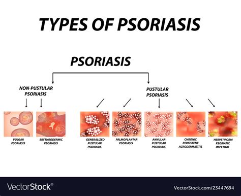 Types Of Psoriasis Pustular And Not Pustular Vector Image