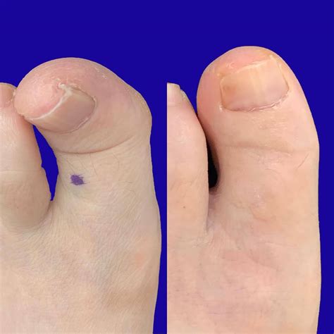 Hammer Toe Pictures Before And After Before And After