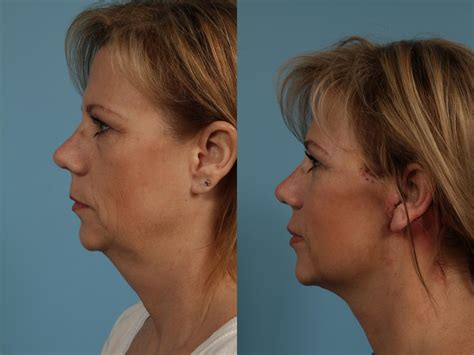 Neck Lift Before And After Photos Patient 275 Chicago Il Tlkm