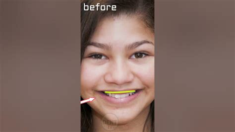 Zendaya Teeth Before And After Now And Then Of Hollywood Celebrity Coleman Whitening And Braces