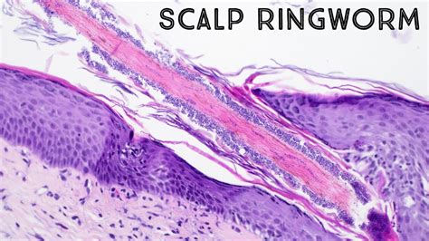 Ringworm Under Microscope Hair Follicle Fungus In Scalp Aka Tinea
