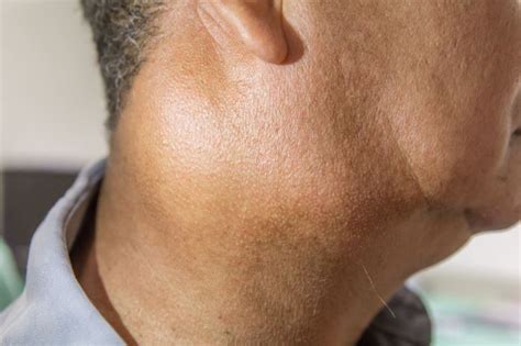 These Are The Most Common Signs Of Lymphoma Like Swollen Lymph Nodes
