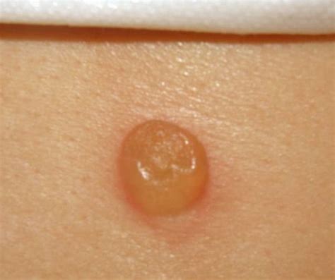 Hobo Spider Bite Pictures Symptoms Stages And Treatment