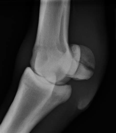 Diagnosis And Management Of Proximal Sesamoid Bone Fractures In The