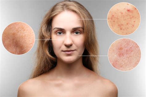What Is Acne Rosacea Symptoms Causes And Treatment