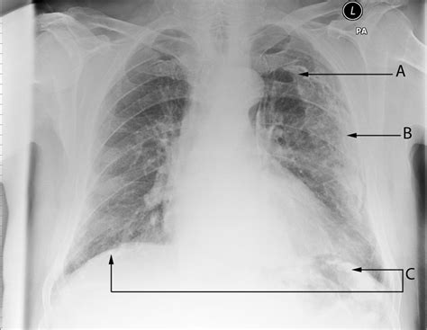 An Overview Of How Asbestos Exposure Affects The Lung The Bmj