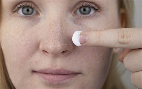 How To Treat Dry Flaky Skin And Rosacea