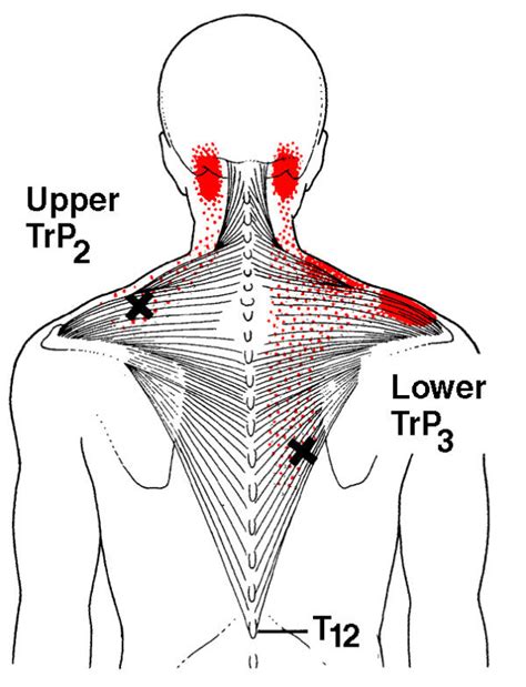 Swollen Trapezius Muscle