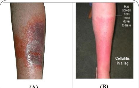 Image A Typical Severe Cellulitis From Clinical Resource Efficiency