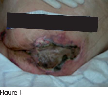 Figure 2:managing pressures ulcers in a resource constrained situation: Figure 1 from Wound care Unstageable pressure ulcers ...