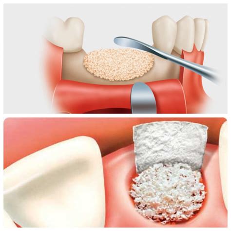 Implante De Hueso Dental Orthofacial Es