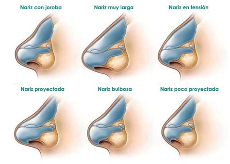 Tipos De Rinoplastia Según Diversos Factores Cirugía Nariz En Madrid