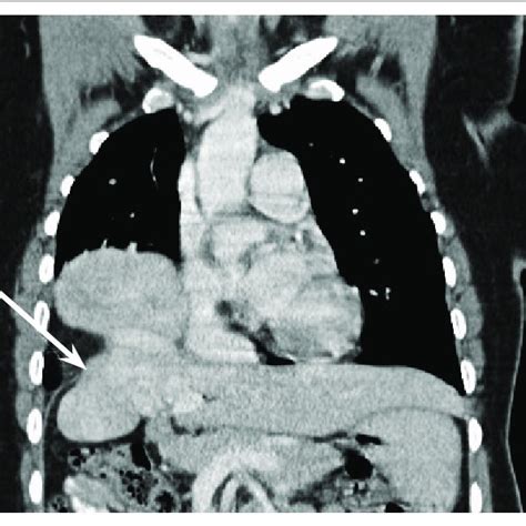 Coronal Contrast Enhanced Ct Of The Chest And Abdomen Which Shows A