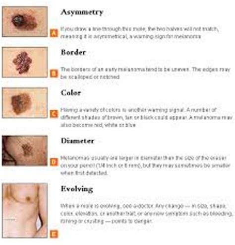 10 Interesting Skin Cancer Facts My Interesting Facts